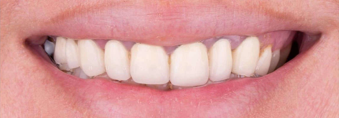 Результат професійної гігієни після лікування