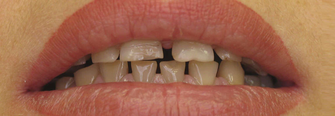 Результат художньої реставрації після лікування