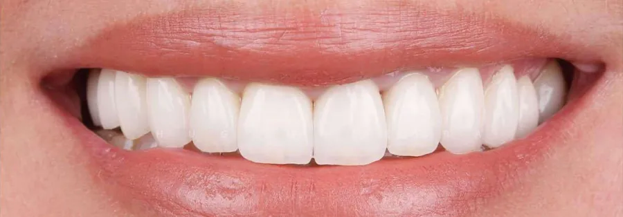 After treatment result