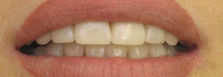 After treatment result