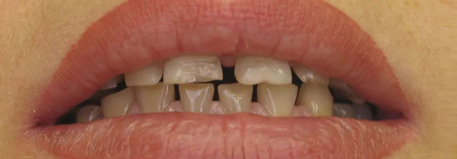 Before treatment